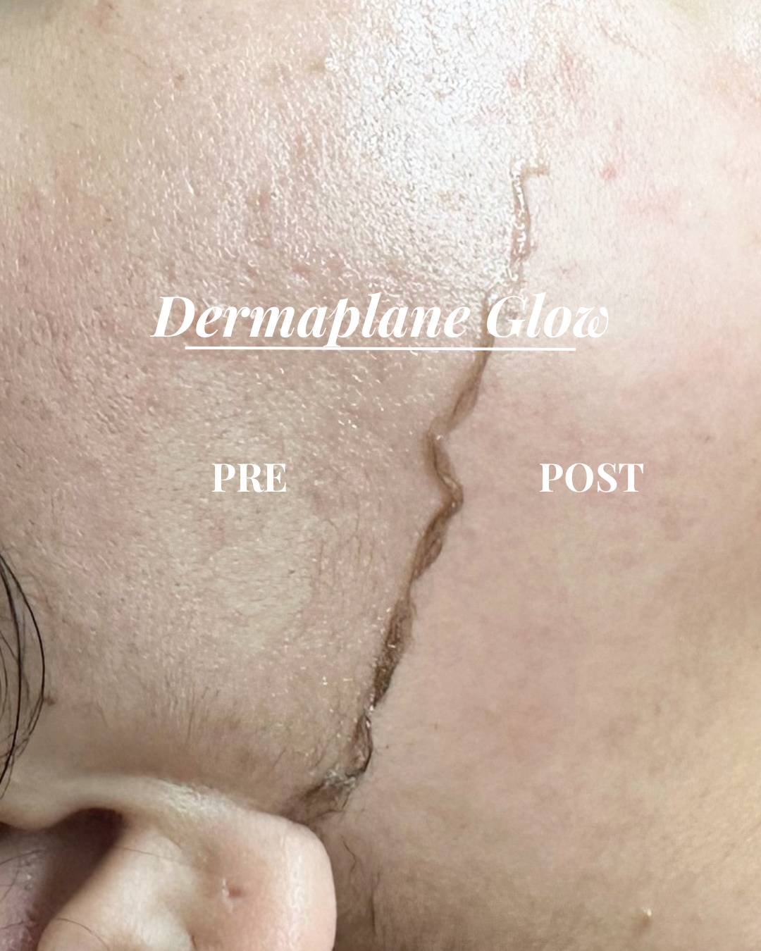 All About The Dermaplane Glow