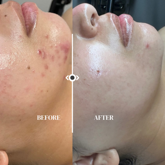 Acne Bootcamp Program